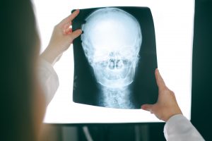 Head Injuries from a Car Accident
