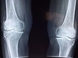 Exactech Knee, Hip and Ankle Recall Lawsuit