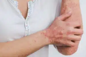 What skin disorders qualify for Social Security disability?