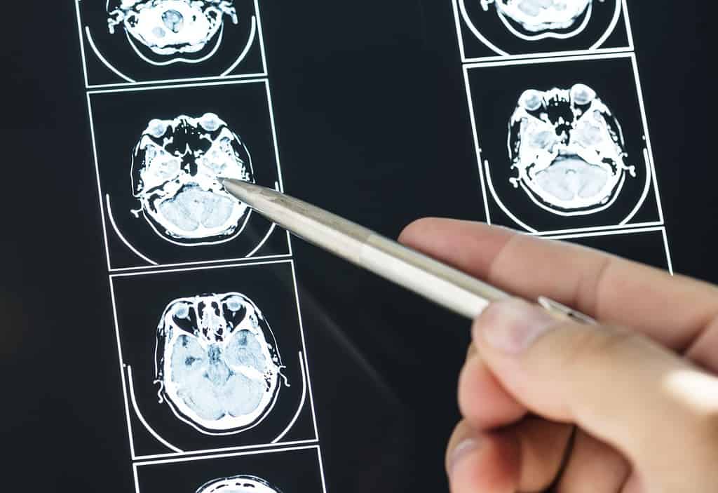 How To Get Disability for Traumatic Brain Injury